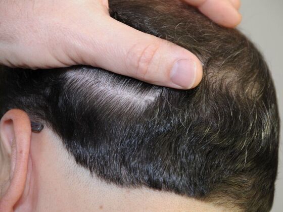 FUT Scars Case 4 - Before