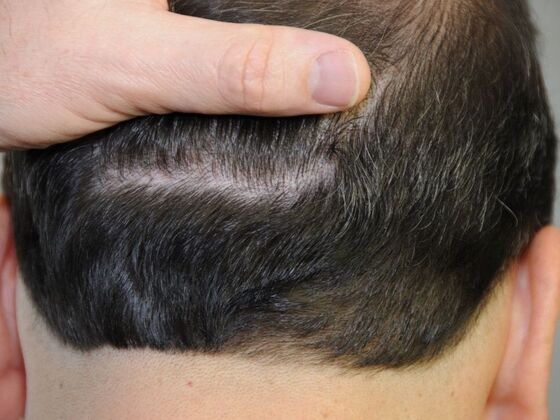 FUT Scars Case 4 - After