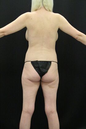 Tummy Tuck: Case 11 - Before