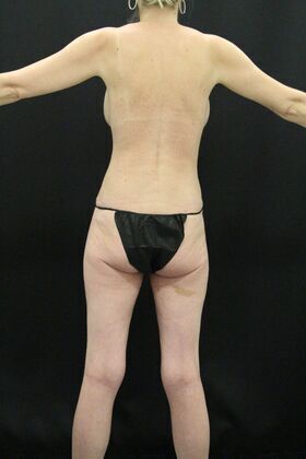 Tummy Tuck: Case 11 - After