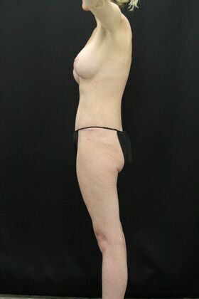 Tummy Tuck: Case 11 - After