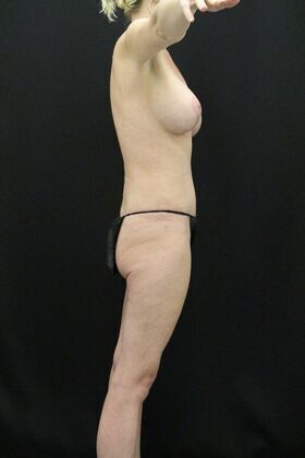 Tummy Tuck: Case 11 - After