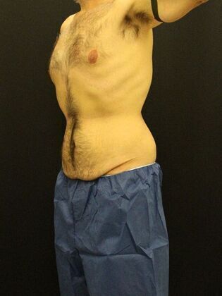 Tummy Tuck Case 12 - Before