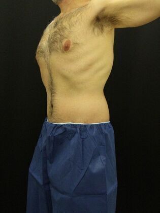 Tummy Tuck Case 12 - After