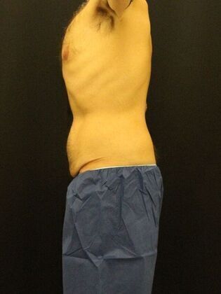 Tummy Tuck: Case 12 - Before
