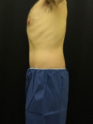 Tummy Tuck: Case 12 - After