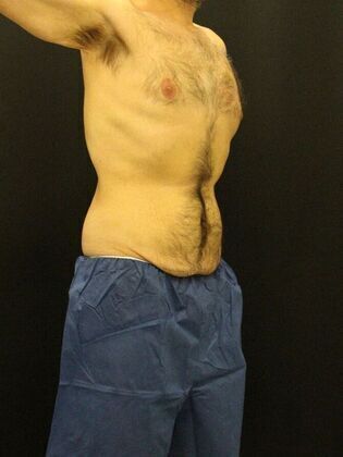 Tummy Tuck: Case 12 - Before