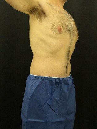 Tummy Tuck: Case 12 - After