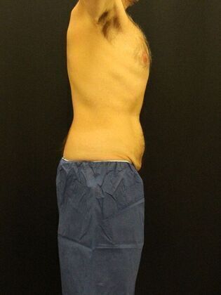 Tummy Tuck: Case 12 - Before