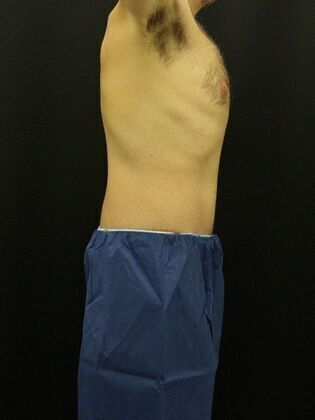 Tummy Tuck: Case 12 - After