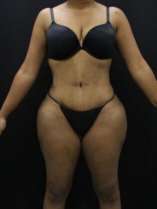 Tummy Tuck: Case 13 - After