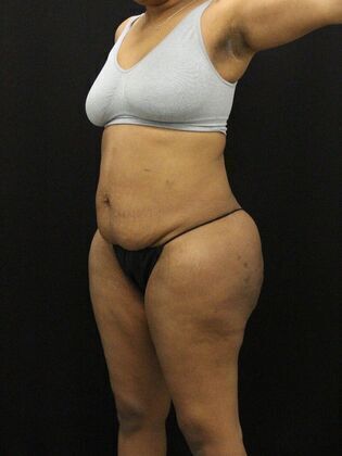 Tummy Tuck: Case 13 - Before
