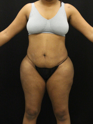 Tummy Tuck: Case 13 - Before