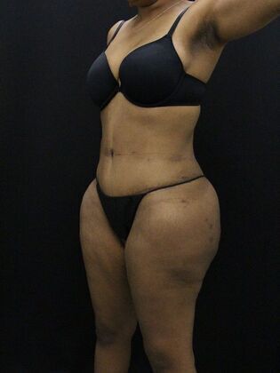 Tummy Tuck: Case 13 - After