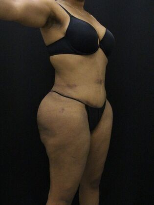 Tummy Tuck: Case 13 - After