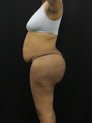 Tummy Tuck Case 13 - Before