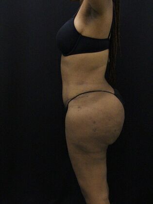 Tummy Tuck Case 13 - After