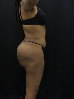 Tummy Tuck: Case 13 - After