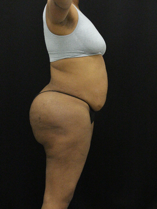 Tummy Tuck: Case 13 - Before