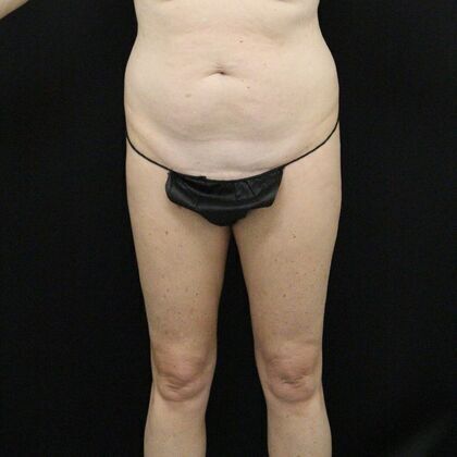 Tummy Tuck Case 14 - Before