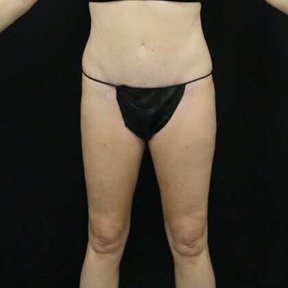 Tummy Tuck Case 14 - After