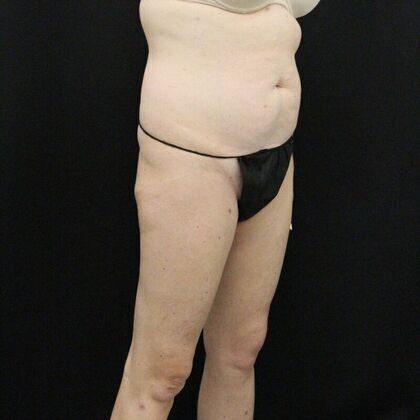 Tummy Tuck: Case 14 - Before