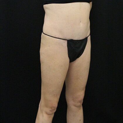 Tummy Tuck: Case 14 - After