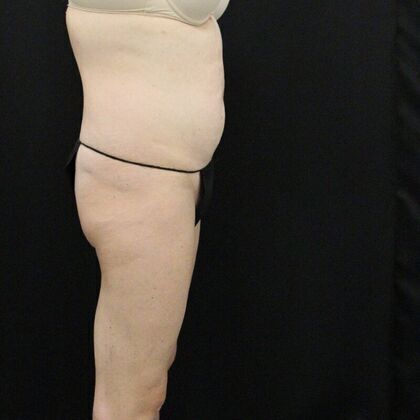 Tummy Tuck: Case 14 - Before