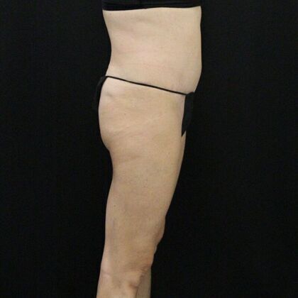 Tummy Tuck: Case 14 - After