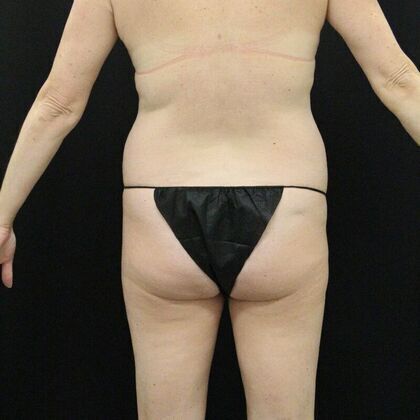 Tummy Tuck: Case 14 - Before