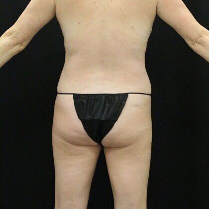 Tummy Tuck: Case 14 - After