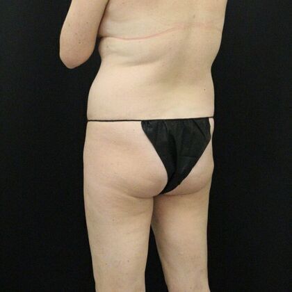 Tummy Tuck: Case 14 - Before