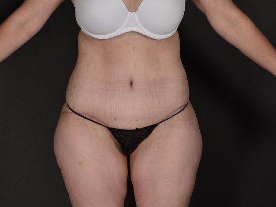 Tummy Tuck Case 17 - After