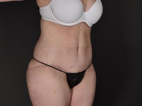 Tummy Tuck: Case 17 - After