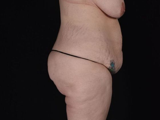 Tummy Tuck: Case 17 - Before