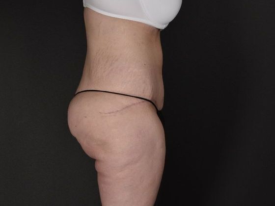 Tummy Tuck: Case 17 - After