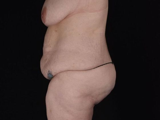 Tummy Tuck: Case 17 - Before