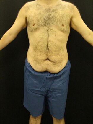 Tummy Tuck Case 18 - Before