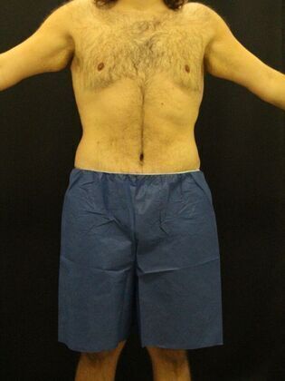 Tummy Tuck Case 18 - After