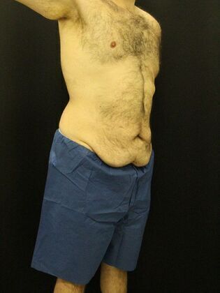 Tummy Tuck: Case 18 - Before