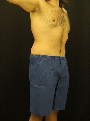 Tummy Tuck: Case 18 - After