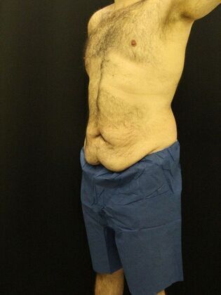 Tummy Tuck: Case 18 - Before