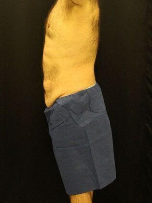 Tummy Tuck: Case 18 - Before