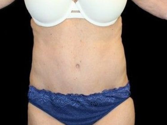 Tummy Tuck: Case 19 - After