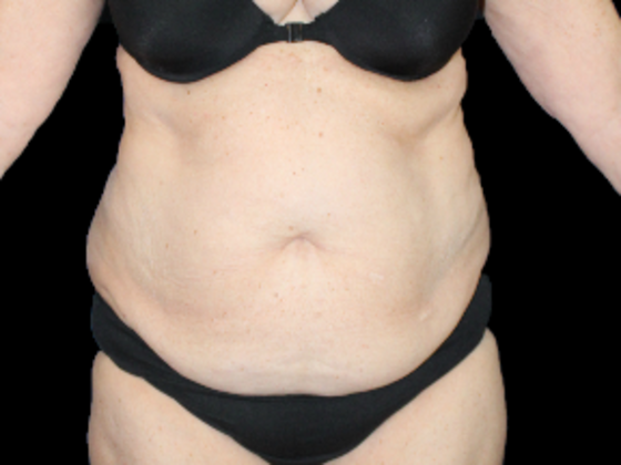 Tummy Tuck: Case 19 - Before