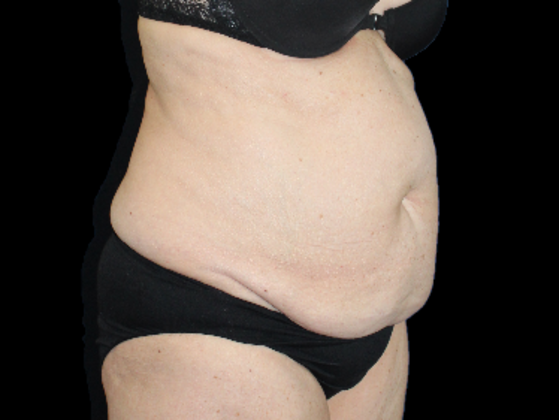 Tummy Tuck Case 19 - Before