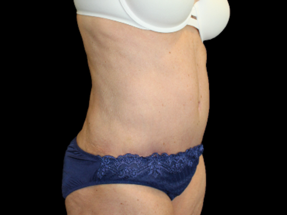 Tummy Tuck Case 19 - After