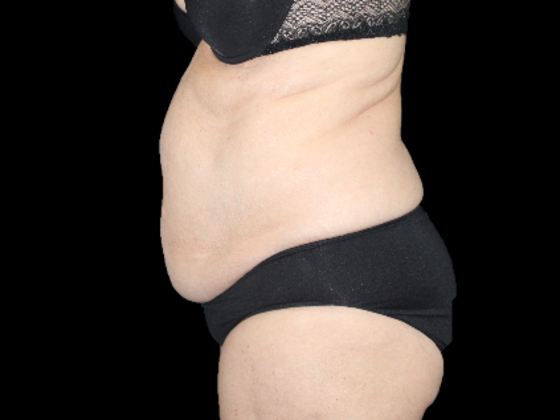 Tummy Tuck: Case 19 - Before