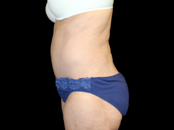 Tummy Tuck: Case 19 - After