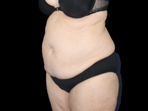 Tummy Tuck: Case 19 - Before